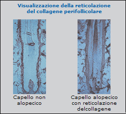 Aminexil fibrosi guaina connettivale