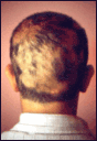 alopecia areata