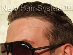 Reinfoltimenti non chirurgici di capelli