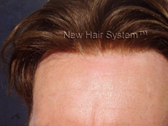 Reinfoltimenti New Gen di New Hair System