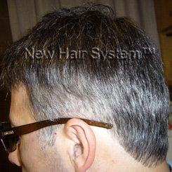 Protesi di capelli