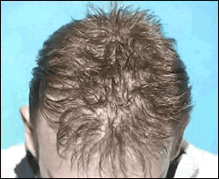 Reinfoltimenti non chirurgici di capelli