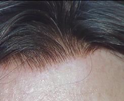 Reinfoltimenti non chirurgici di capelli
