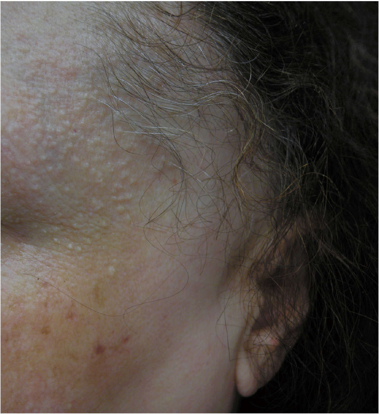 alopecia fibrosante frontale