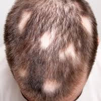 Alopecia areata