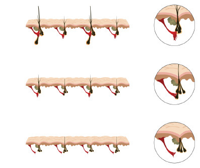 Aga e muscolo erettore del pelo