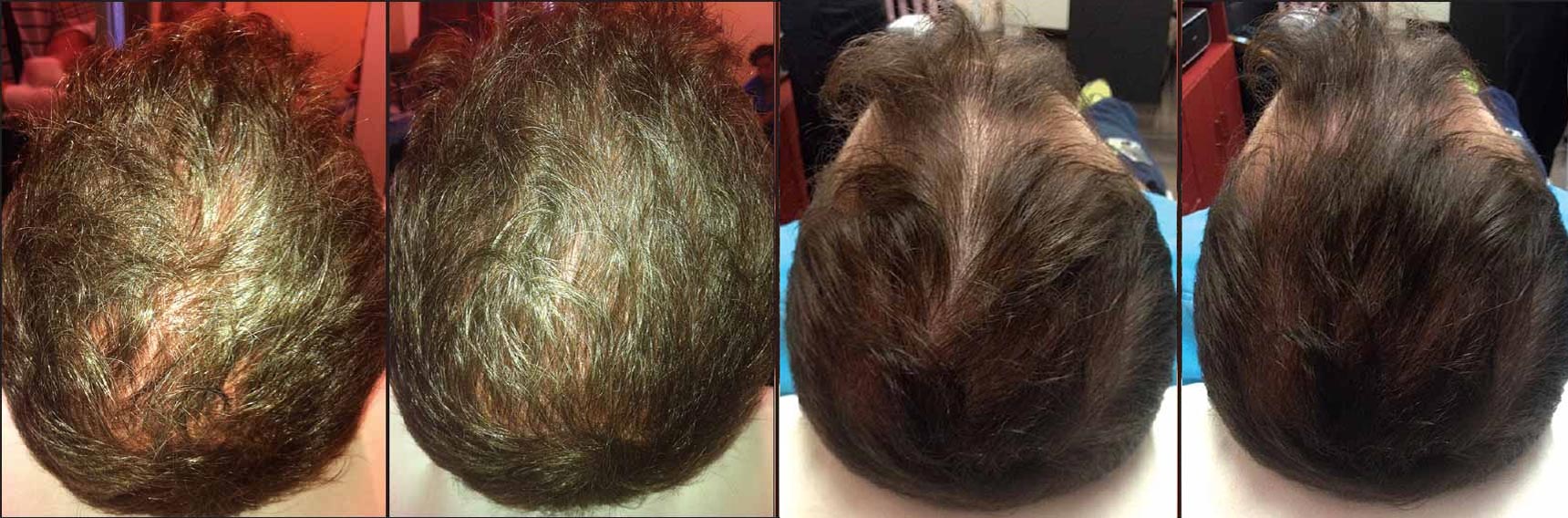 prp Un trattamento anti-calvizie con iniezioni di PRP, Plasma Ricco di Piastrine