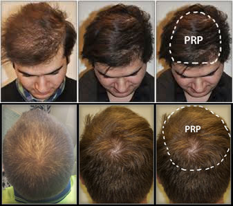 prp capelli prima e dopo