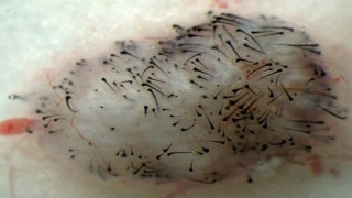 L'impianto nei topi delle cellule della papilla dermica derivate da staminali 