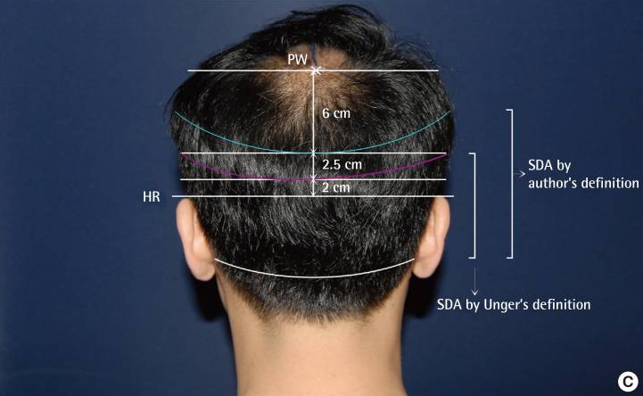 La vertigine del vertex alta alza l'estensione della donor area