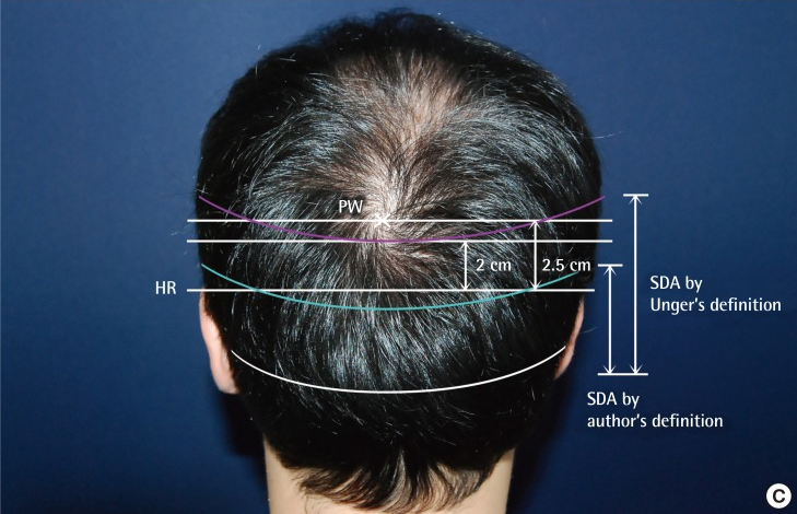 La vertigine del vertex bassa riduce l'estensione della donor area