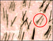 unità follicolare 3 capelli unità follicolare 3 capelli